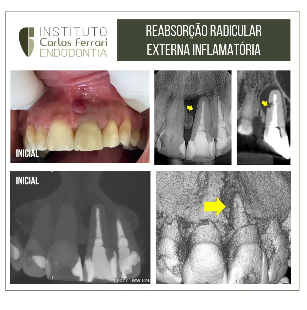 Reabsorção radicular externa e cirurgia paraendodôntica
