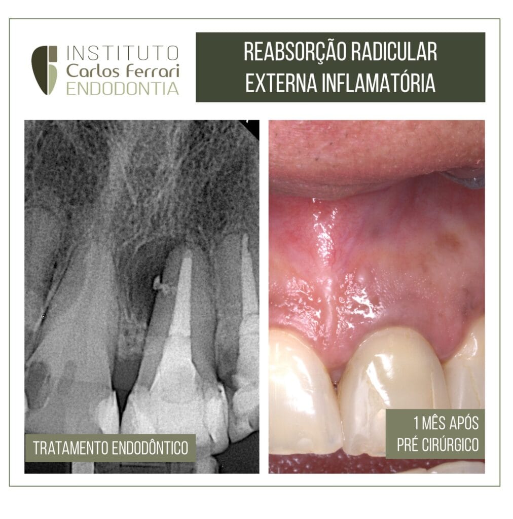 Reabsorção radicular externa e cirurgia paraendodôntica