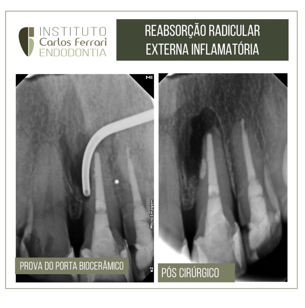 Reabsorção radicular externa e cirurgia paraendodôntica