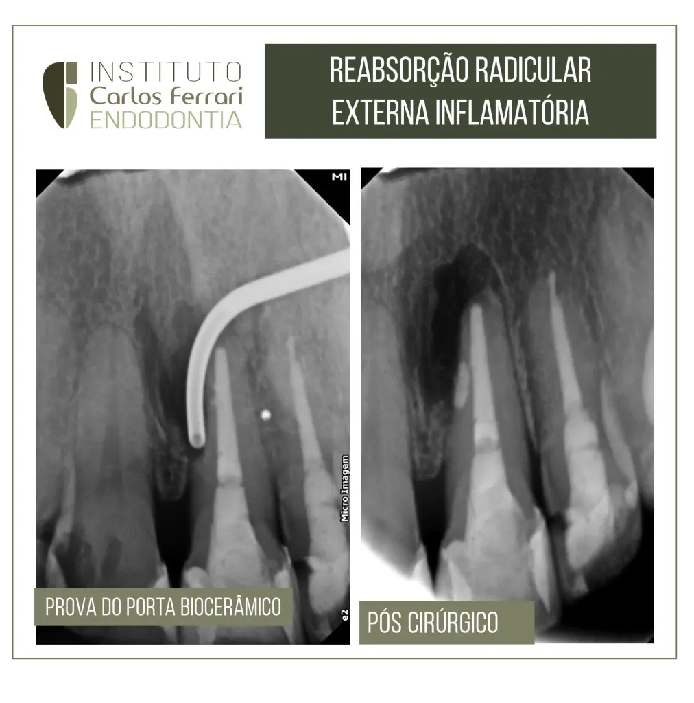 Reabsorção radicular externa e cirurgia paraendodôntica