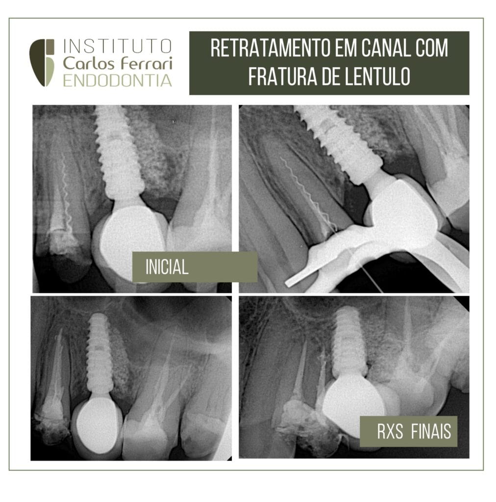 fratura de lentulo. Resolução conservadora.