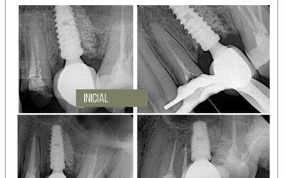 fratura de lentulo. Resolução conservadora.