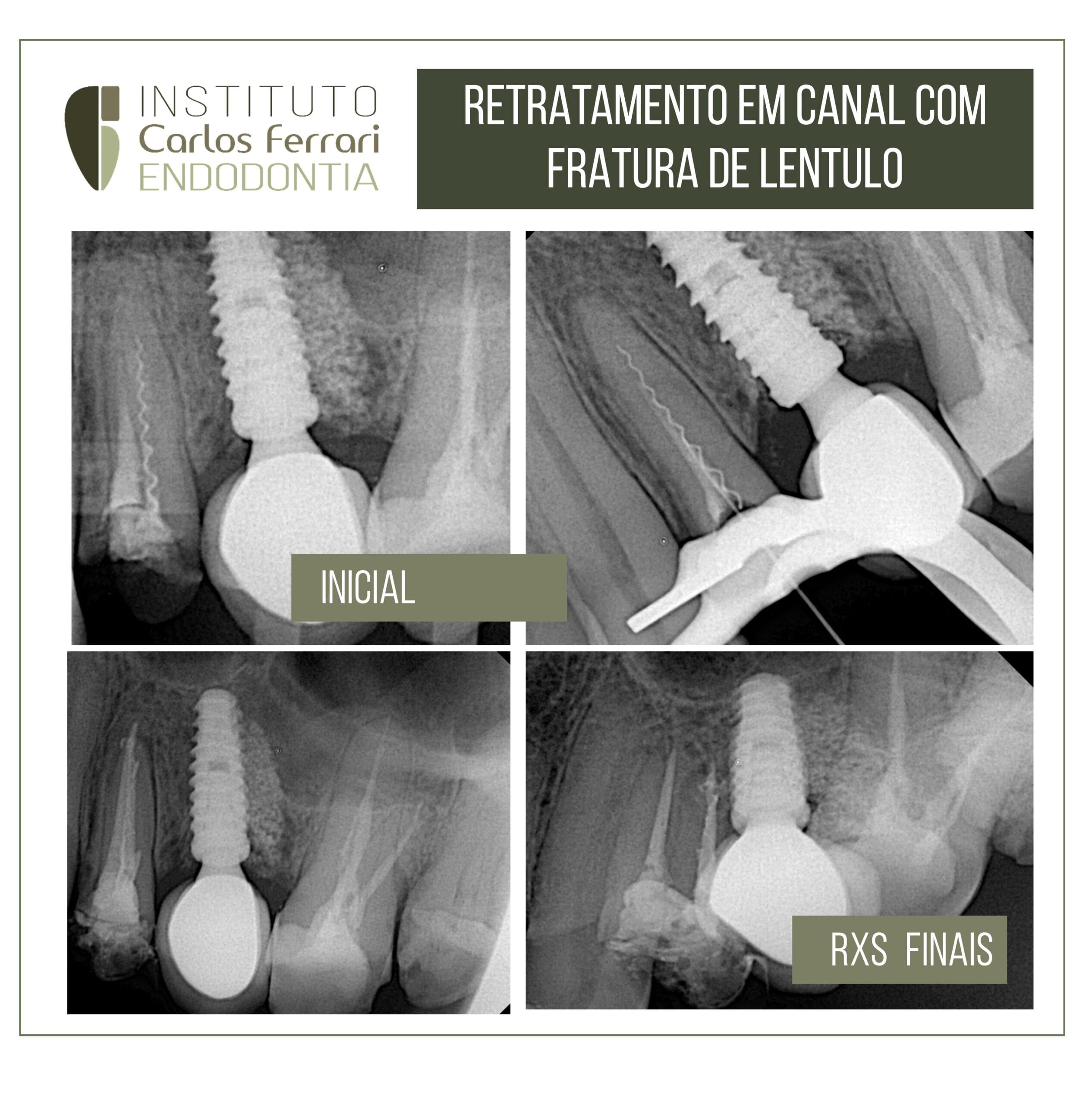 fratura de lentulo. Resolução conservadora. fratura de lentulo. Resolução conservadora.