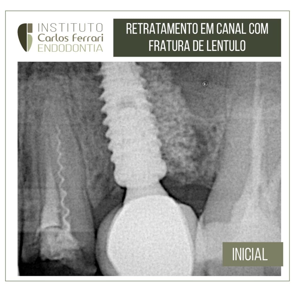 fratura de lentulo. Resolução conservadora.