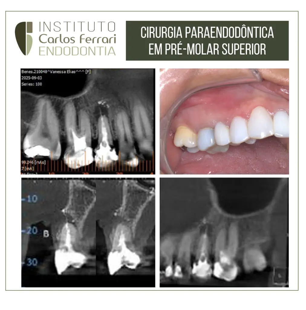Cirurgia paraendodôntica em pré molar com pino de fibra