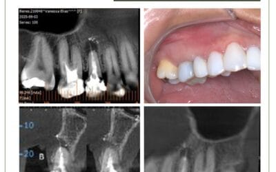 Cirurgia paraendodôntica em pré molar com pino de fibra
