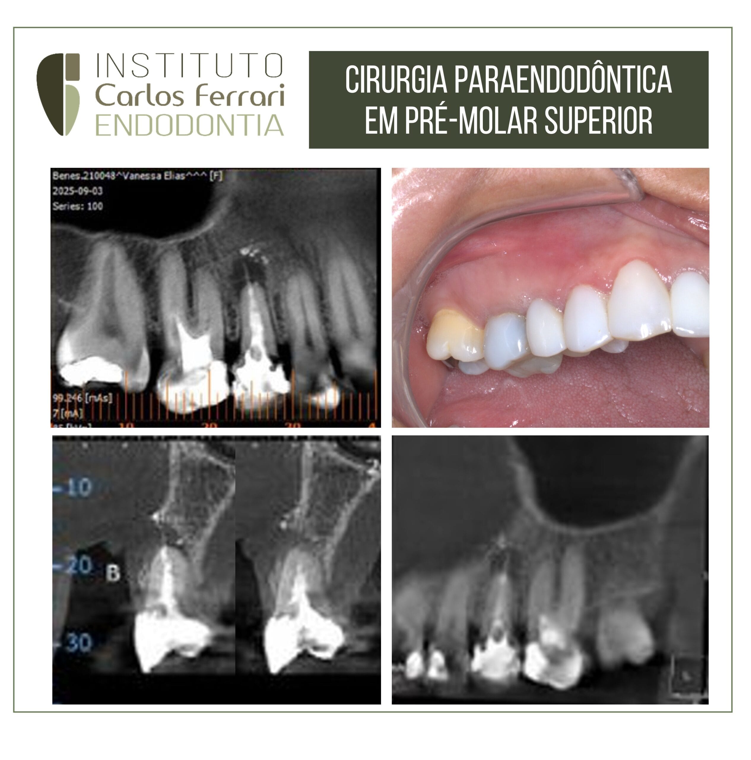 Cirurgia paraendodôntica em pré molar com pino de fibra