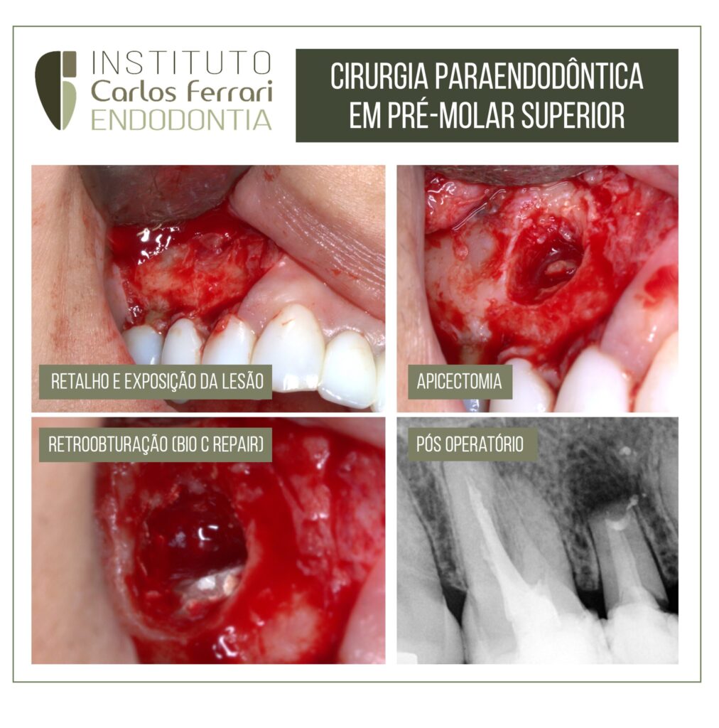 Cirurgia paraendodôntica em pré molar com pino de fibra