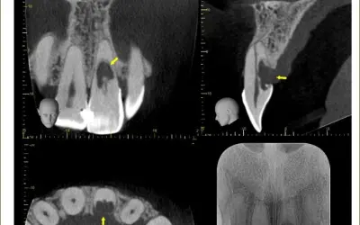 Reabsorção radicular cervical externa