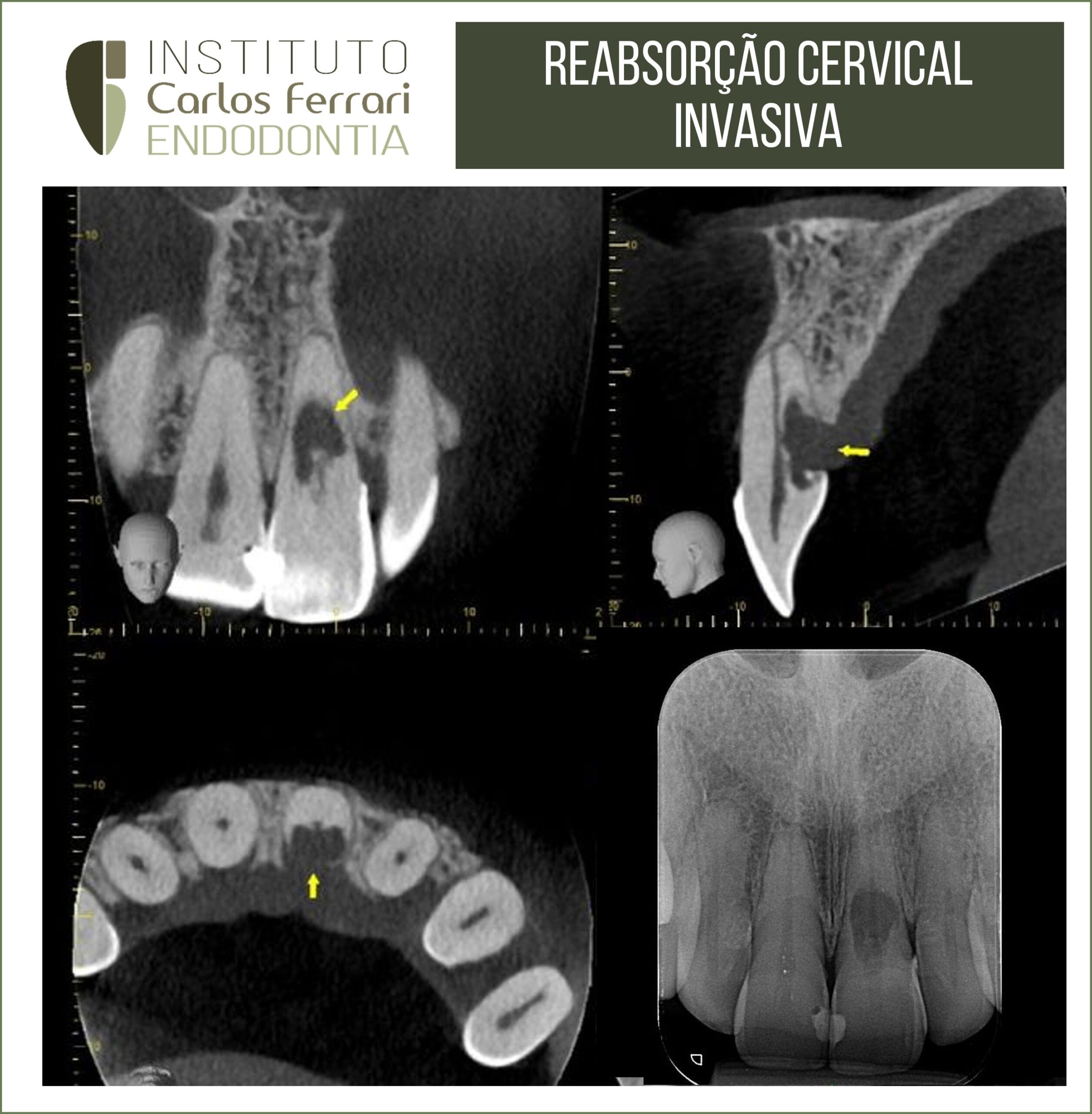 Reabsorção radicular cervical externa