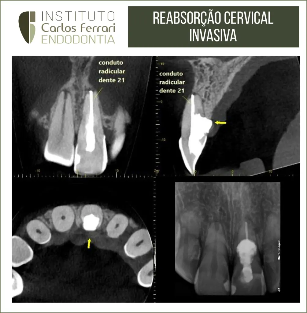 Reabsorção radicular cervical externa