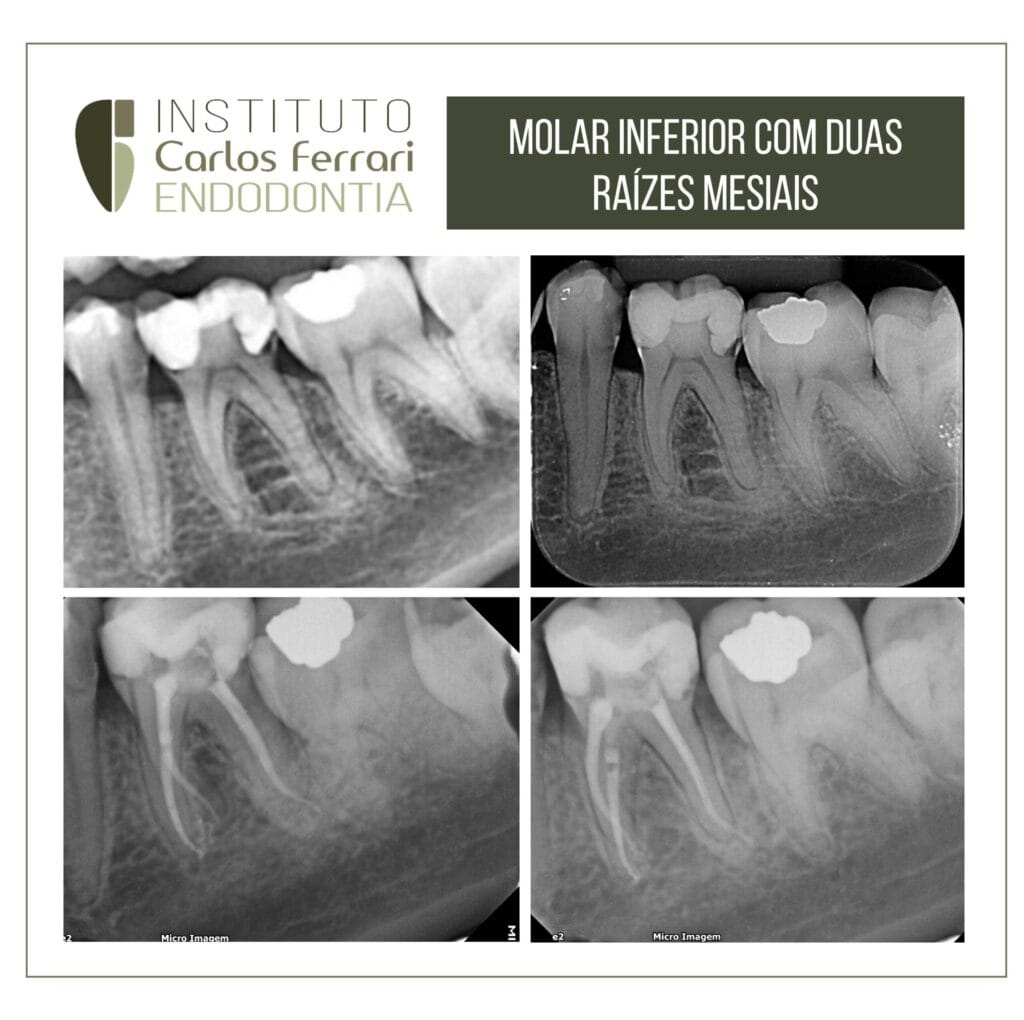 Molar inferior com duas raizes mesiais.