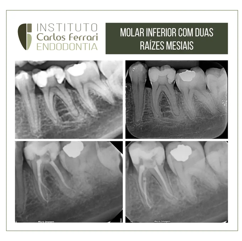 Molar inferior com duas raizes mesiais.