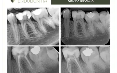 Molar inferior com duas raizes mesiais.