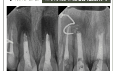 retratamento endodôntico em dentes anteriores com rizogênese incompleta