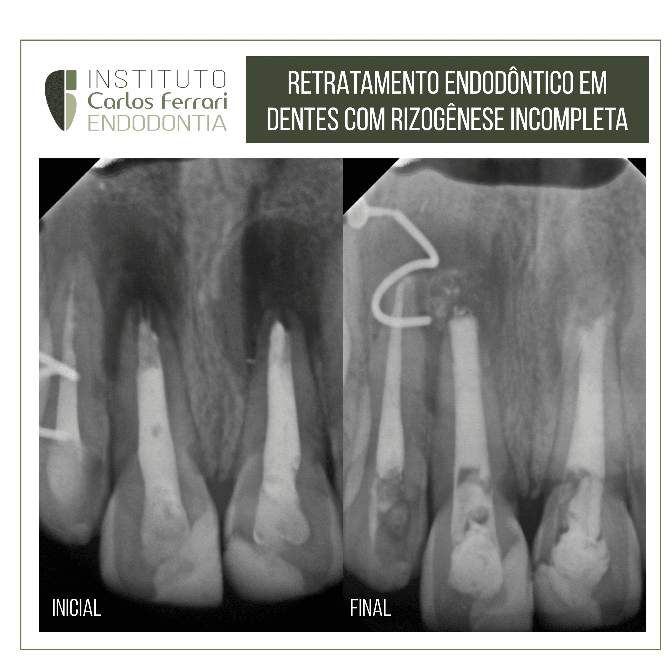 retratamento endodôntico em dentes anteriores com rizogênese incompleta