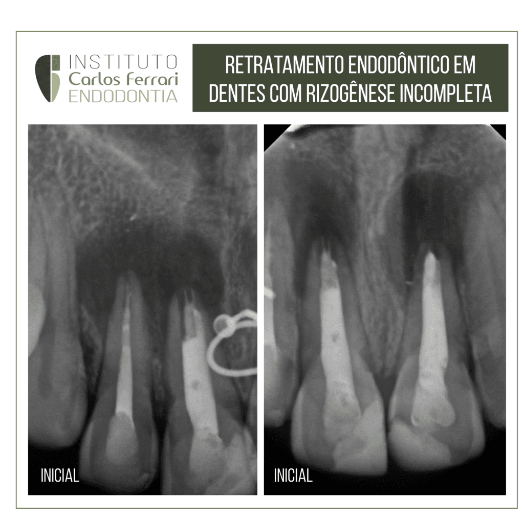 retratamento endodôntico em dentes anteriores com rizogênese incompleta