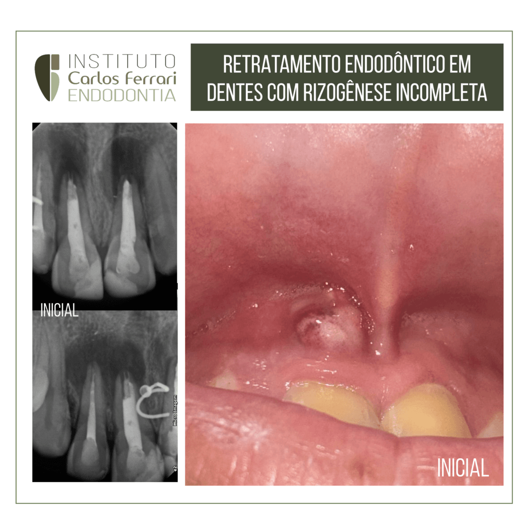 retratamento endodôntico em dentes anteriores com rizogênese incompleta