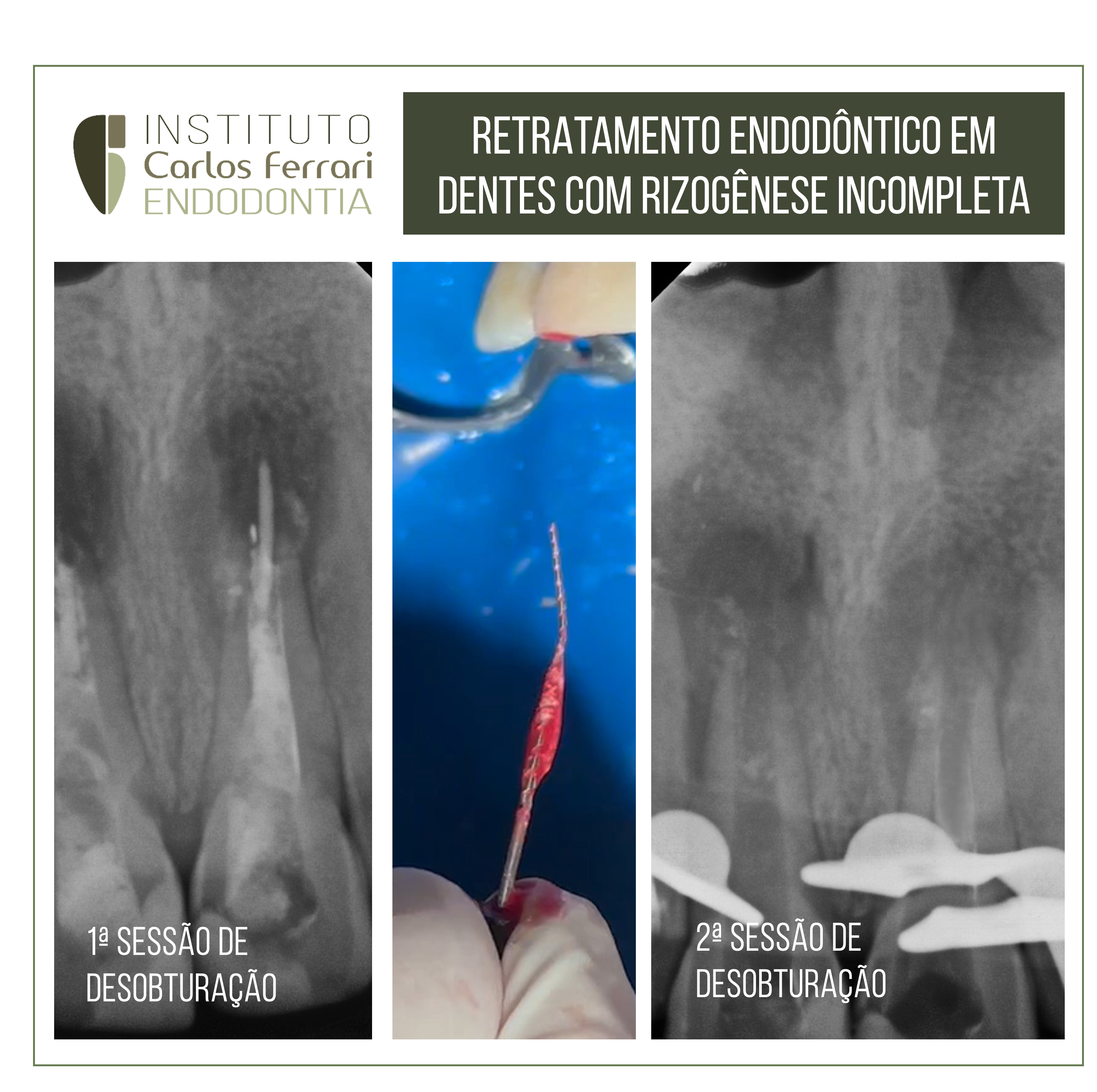 retratamento endodôntico em dentes anteriores com rizogênese incompleta