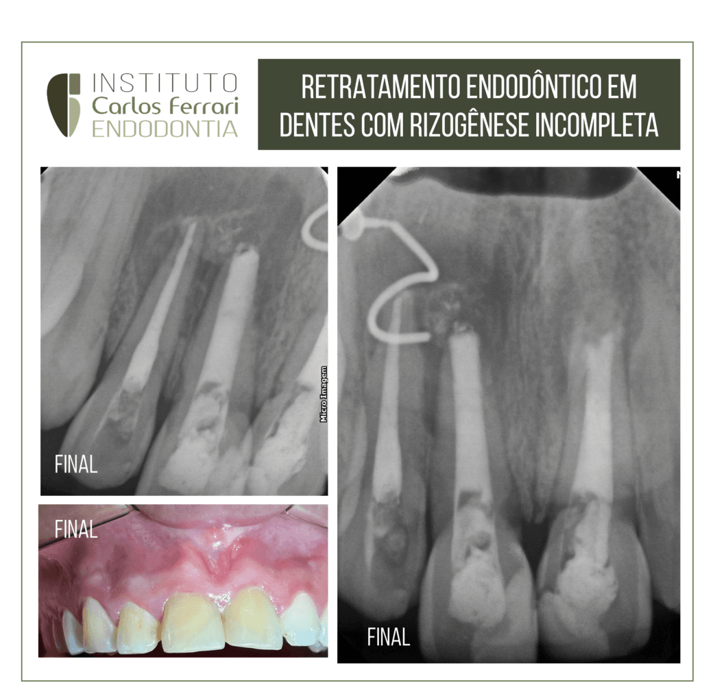 retratamento endodôntico em dentes anteriores com rizogênese incompleta