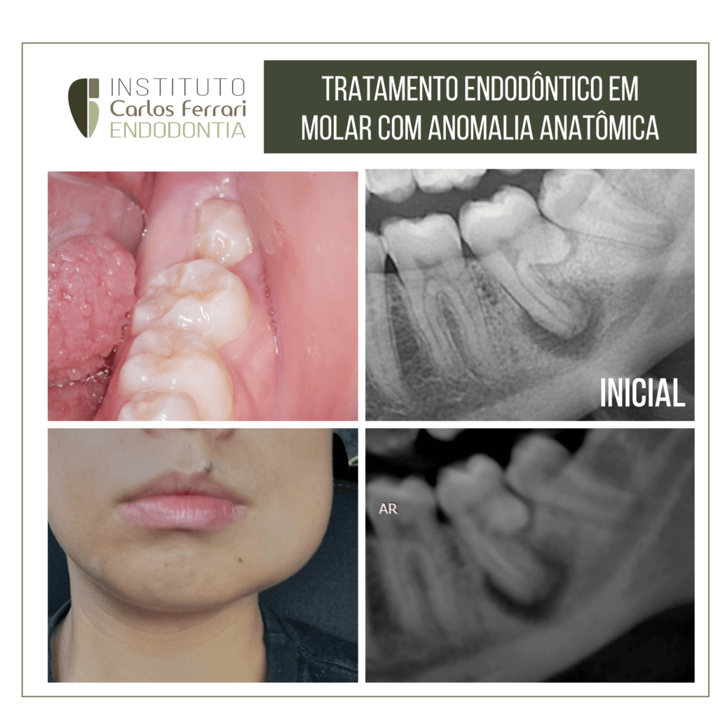 Tratamento endodôntico em molar inferior com anormalidade anatômica