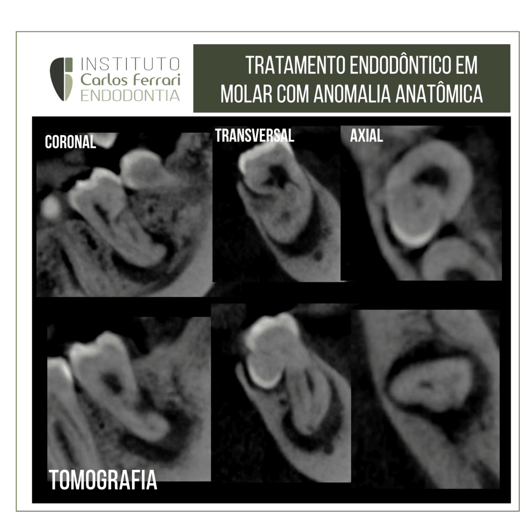 Tratamento endodôntico em molar inferior com anormalidade anatômica