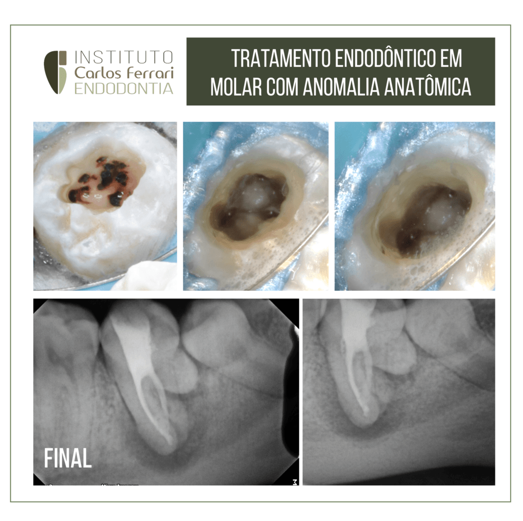 Tratamento endodôntico em molar inferior com anormalidade anatômica