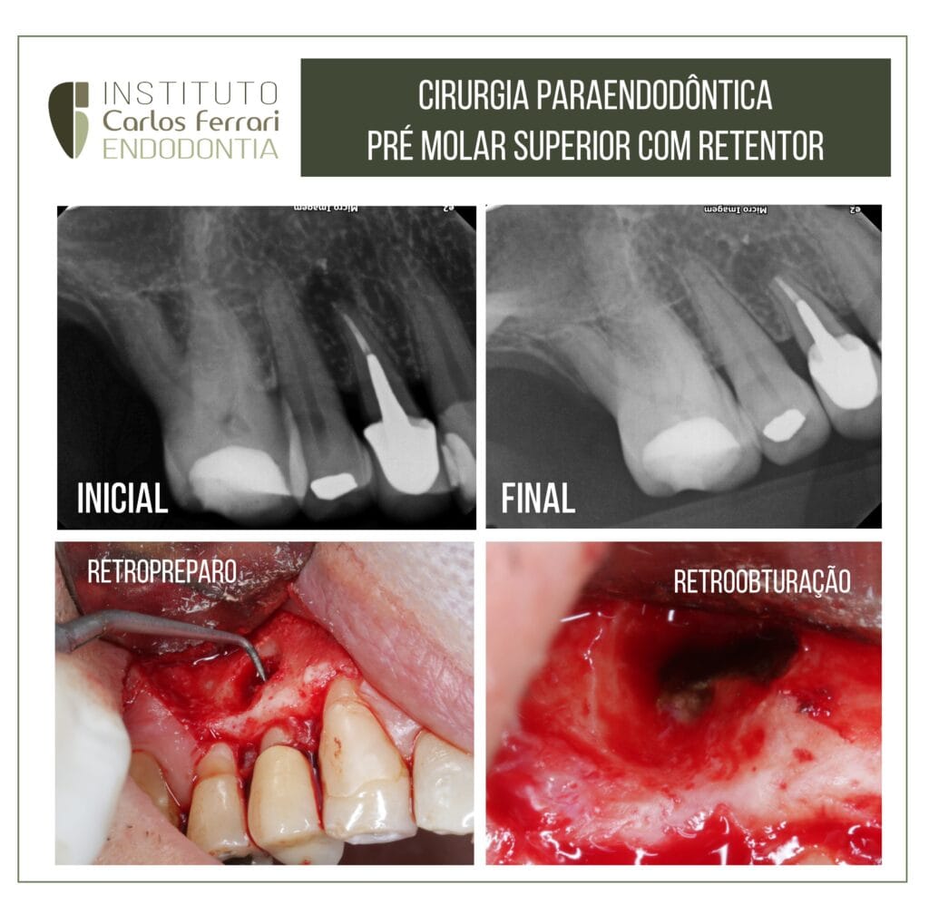 Cirurgia paraendodôntica em pré molar com retentor