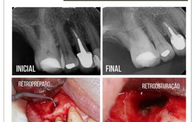 Cirurgia paraendodôntica em pré molar com retentor
