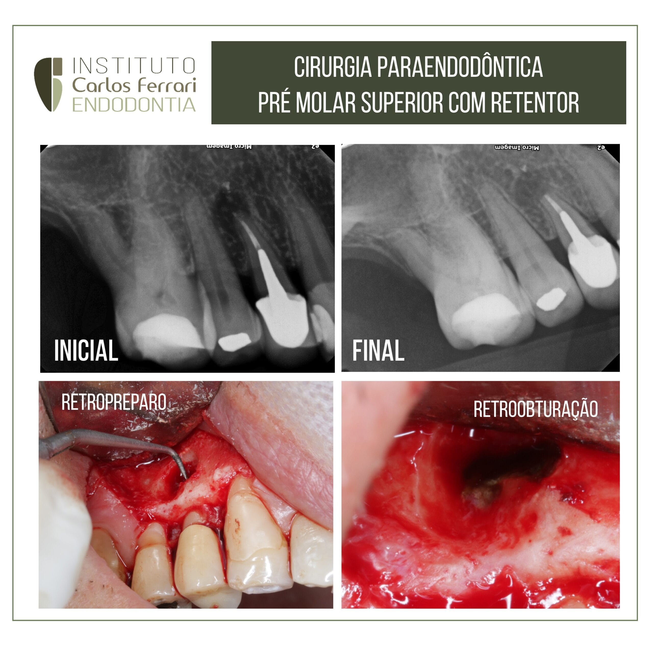 Cirurgia paraendodôntica em pré molar com retentor