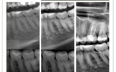 Displasia cementária periapical com proservação de 3 anos.