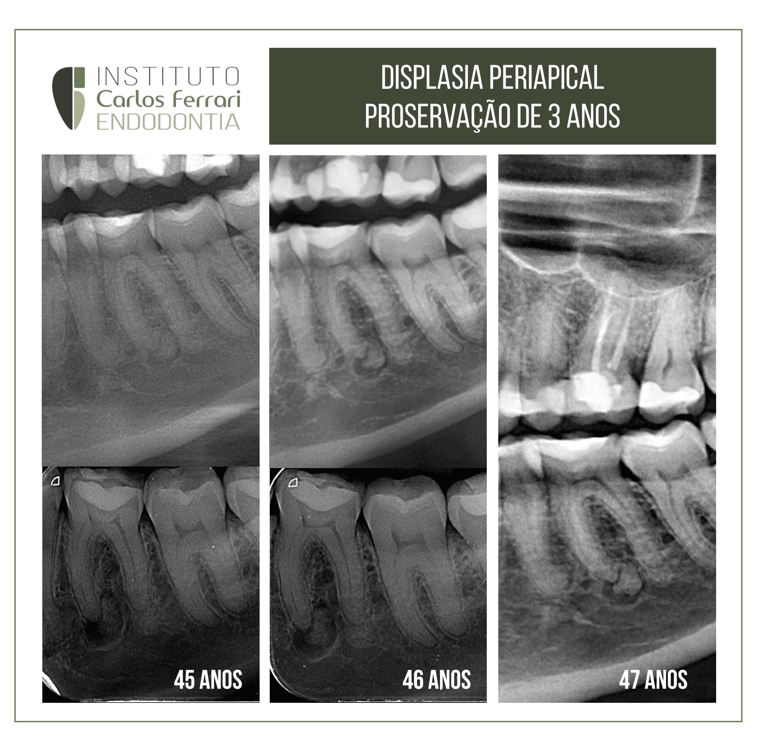 Displasia cementária periapical com proservação de 3 anos. Displasia cementária periapical com proservação de 3 anos.