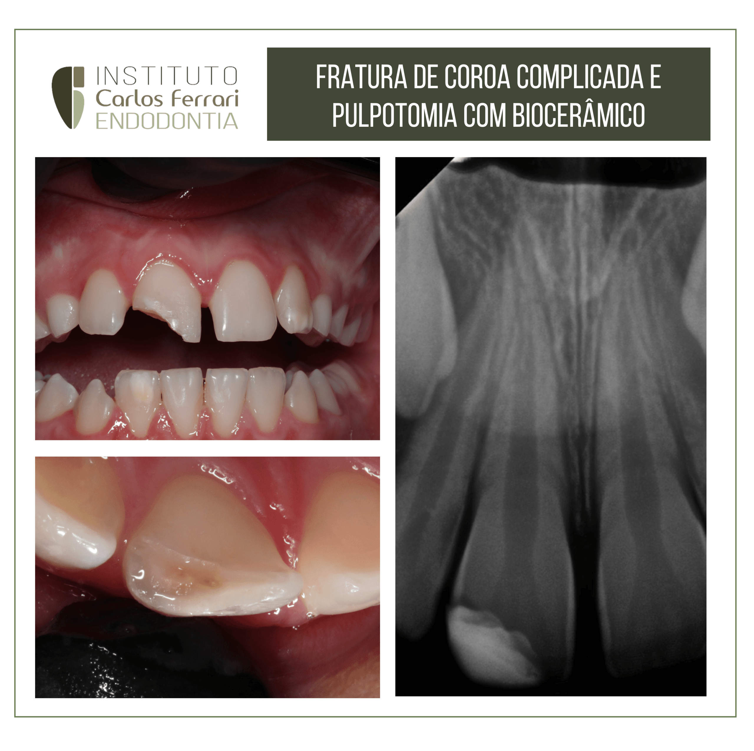 Fratura de coroa complicada e capeamento pulpar direto