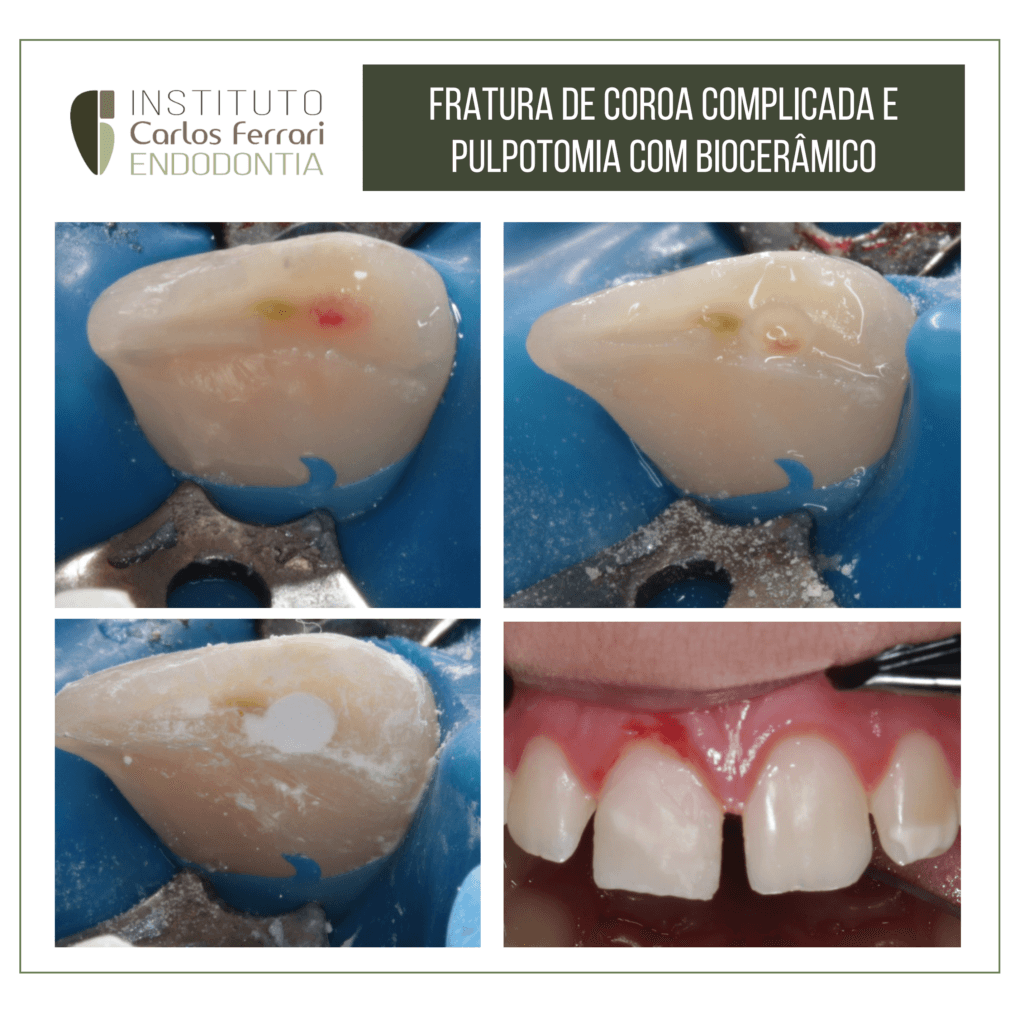 Fratura de coroa complicada e capeamento pulpar direto