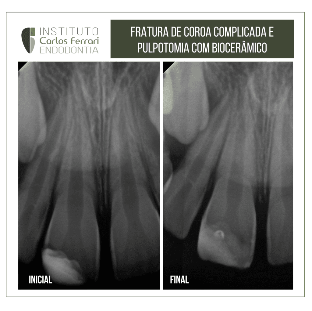 Fratura de coroa complicada e capeamento pulpar direto